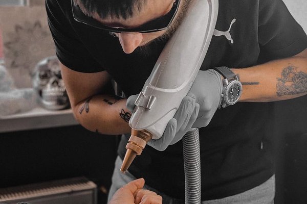 Laser tattoo removal in The Hague