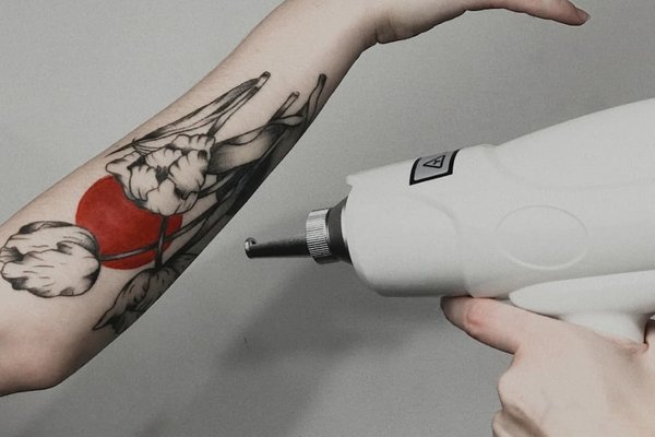 Laser Tattoo Verwijdering in Groningen