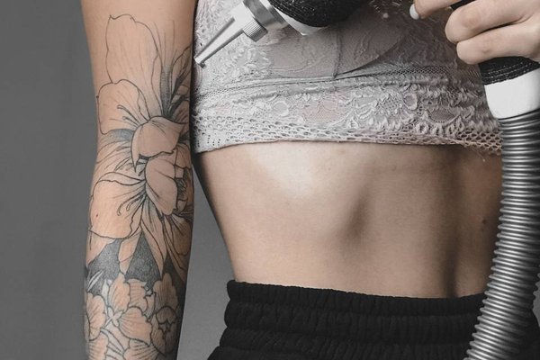 Laser tattoo removal in Breda
