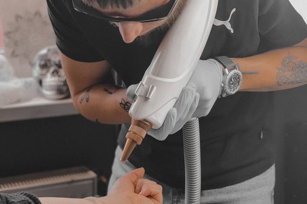 Laser tattoo removal in Haarlem