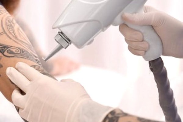 Tattoo Removal in Eindhoven