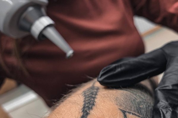 Laser Tattoo Verwijdering in Groningen